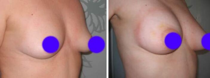 Senos antes y después de la introducción de rellenos basados ​​en el ácido hialurónico