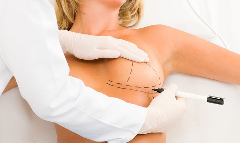 Madría de mammoplastia