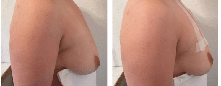 Antes y después del levantamiento de senos con hilo