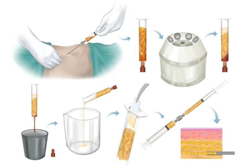 Eliminación de grasa de áreas problemáticas, procesamiento e inyección en el tejido mamario.