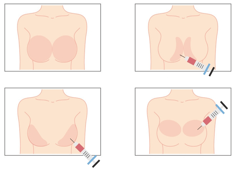 Sitios para inyectar ácido hialurónico en el seno.