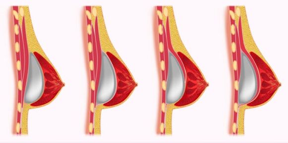 Métodos para instalar implantes para agrandar los senos.